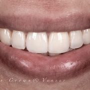 Restoring " WINDOW OF THE  SMILE"  is abslutely a challenge !